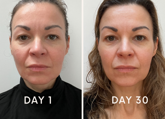 Before and after pictures of my exosomes microneedling facial 30 days apart
