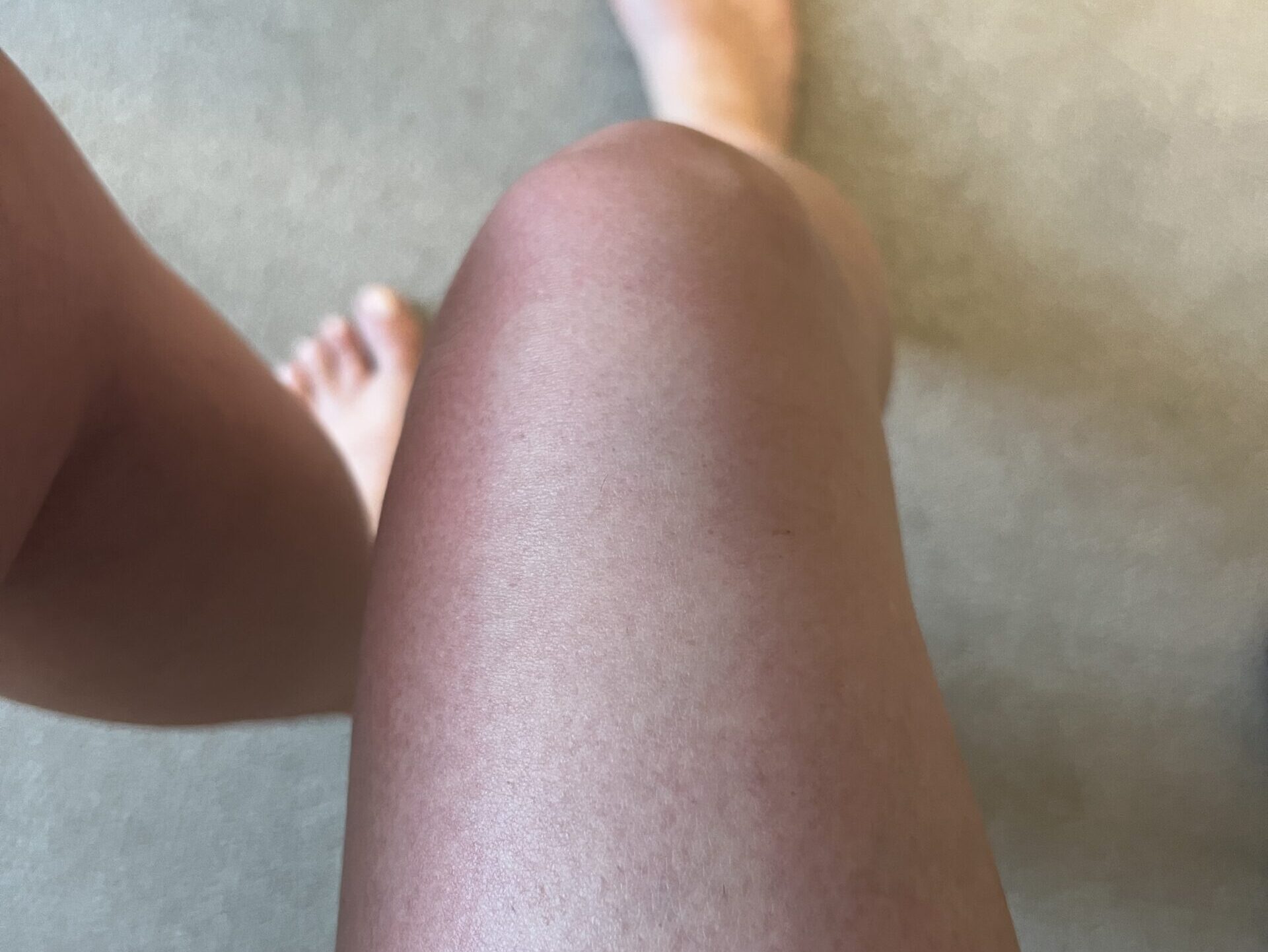 A knee with white strip down the middle where sunblock was applied surrounded by red sunburnt skin.