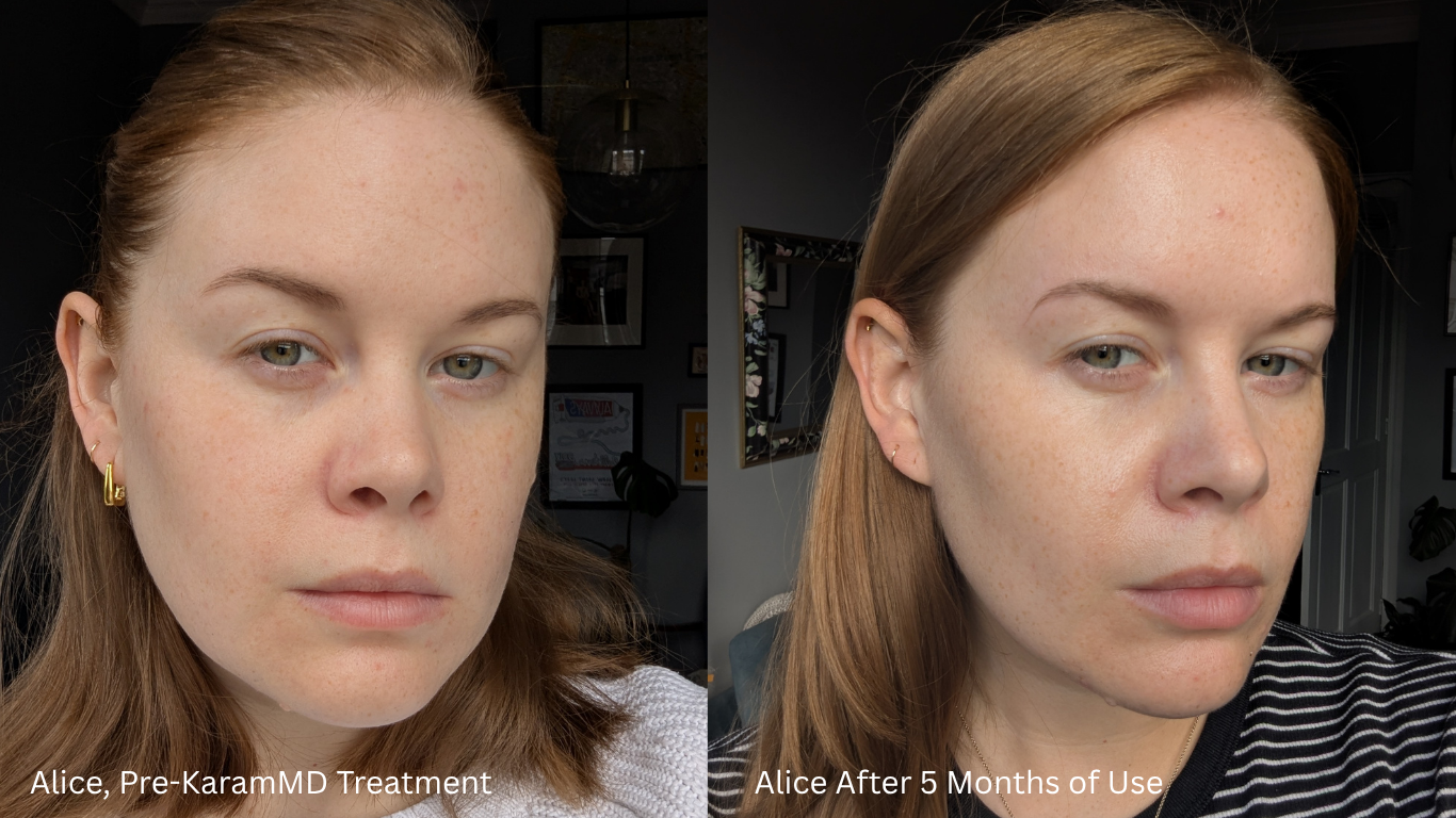 Alice Hinds pictured left pre-treatment and right five months after using KaramMD