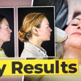 Photo of Clare Johnston having Sofwave treatment with her before and afters alongside