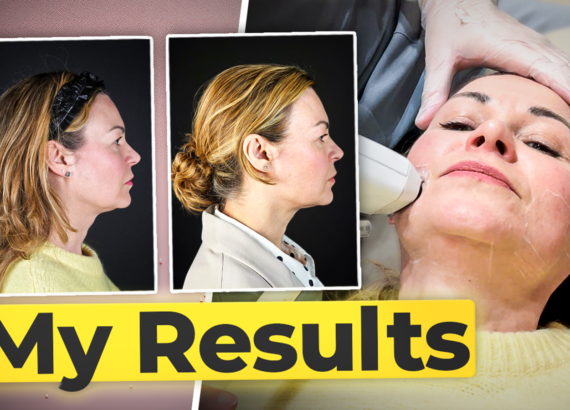 Photo of Clare Johnston having Sofwave treatment with her before and afters alongside