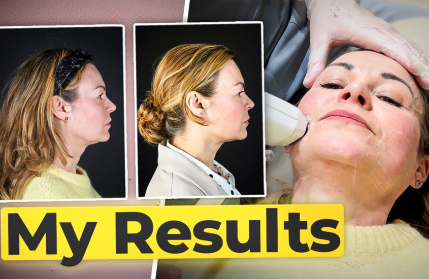 Is Sofwave A Non-Surgical Facelift? My 3-Month Review & Results